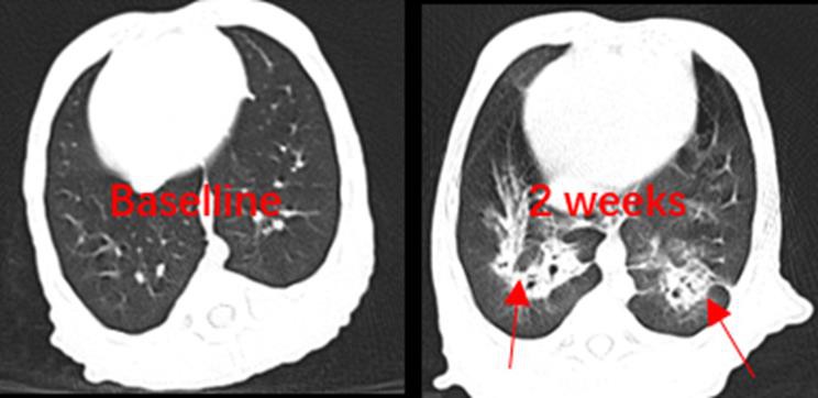 COPD-Prisys-Biotech COPD-Prisys-Biotech